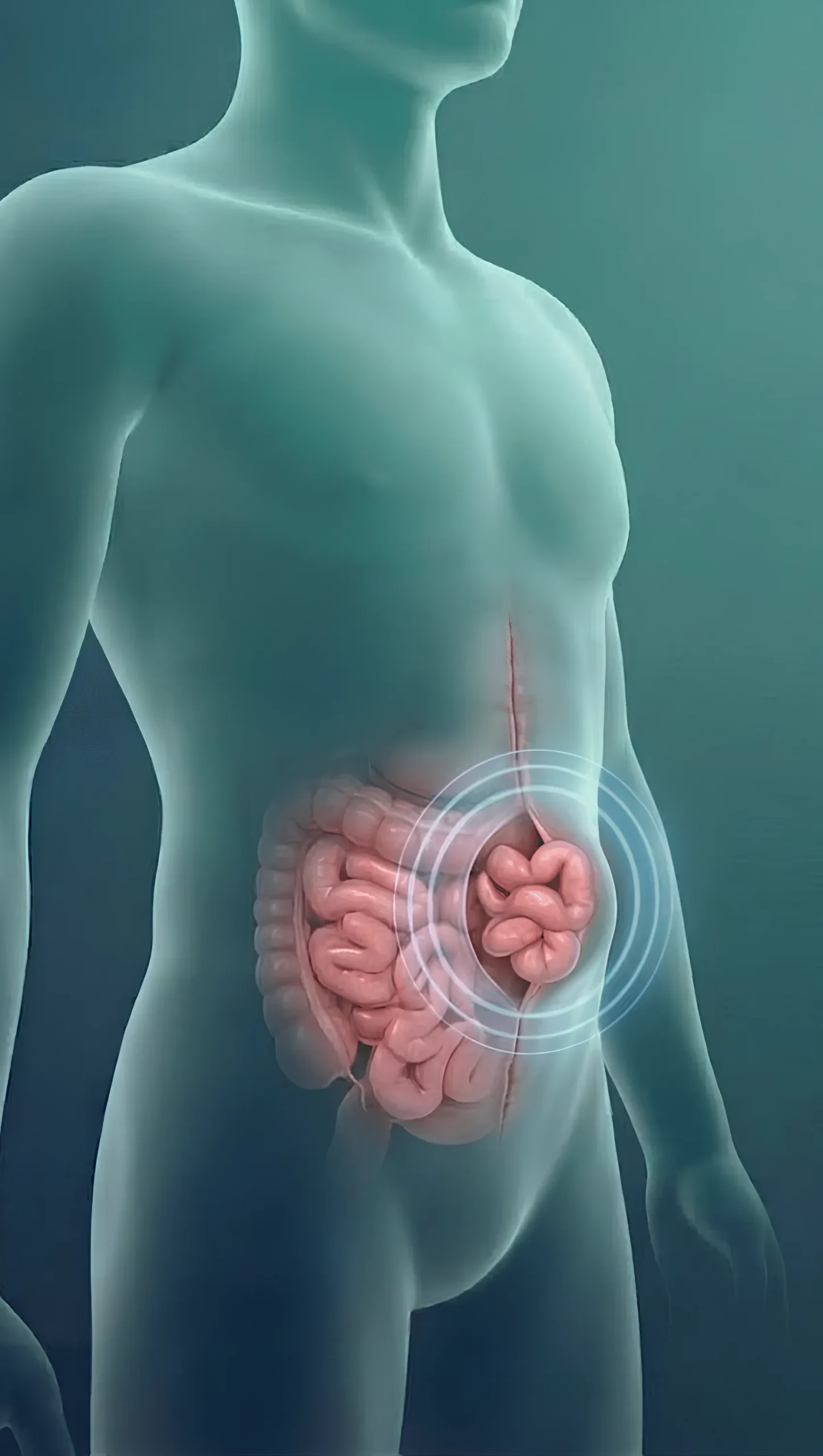 Diagram of a ventral and incisional hernia of the abdominal wall