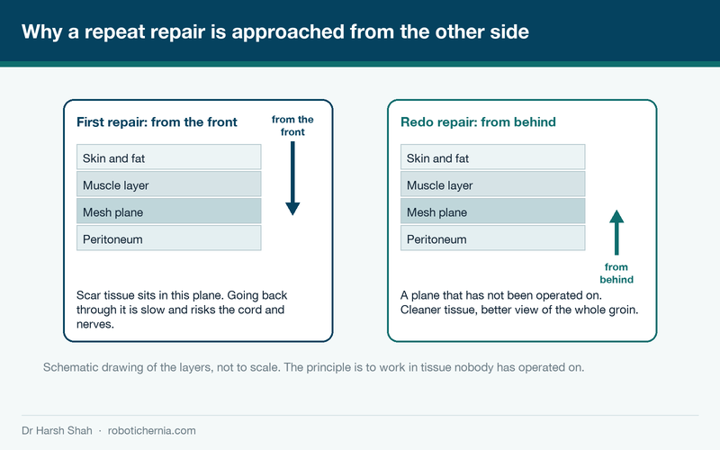 Schematic diagram showing the front and back approach planes used for a first and a repeat hernia repair