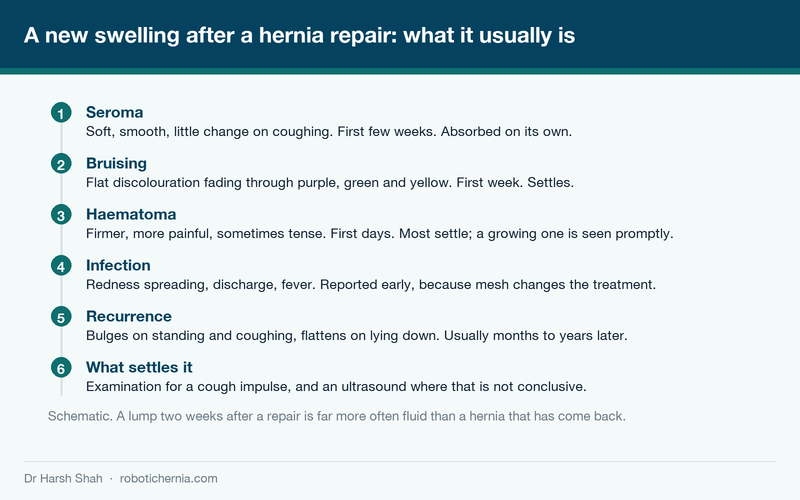 Schematic of the four causes of new swelling after a hernia repair: seroma, haematoma, infection and recurrence